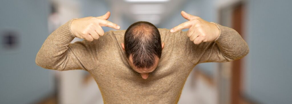 Ursachen für Haarausfall: die androgenetische Alopezie