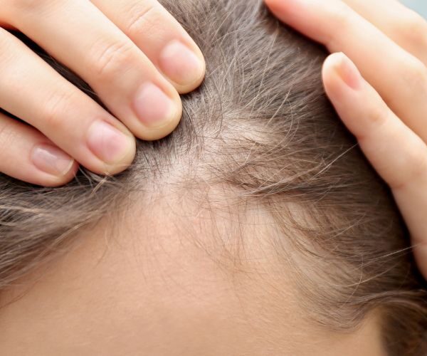 Die Haare für eine Haartransplantation rasieren: Ist das notwendig?